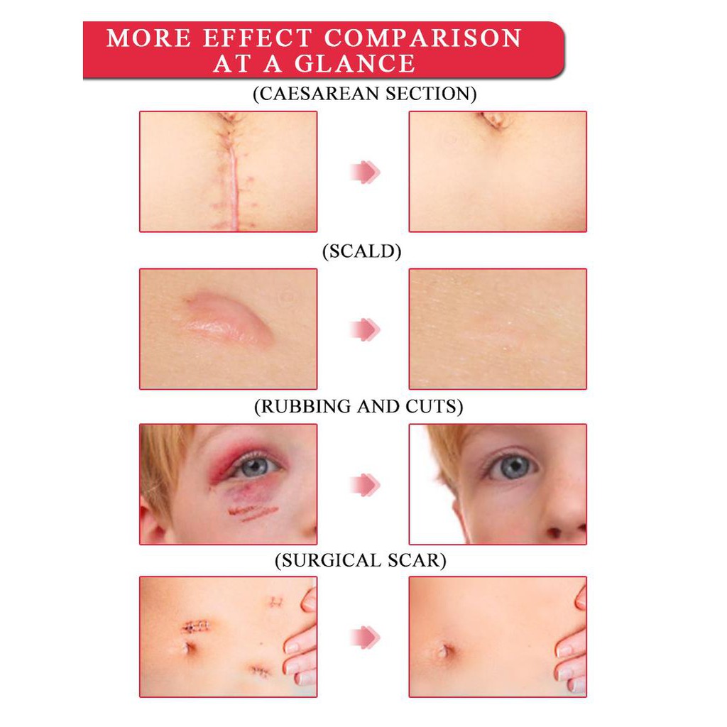[100% Asli] Krim Penghilang Bekas Luka Bekas Operasi Luka Jerawat Tanda Luka Bakar untuk Perawatan Perbaikan Bintik-bintik Jerawat Korektor Pigmentasi Tubuh 15G