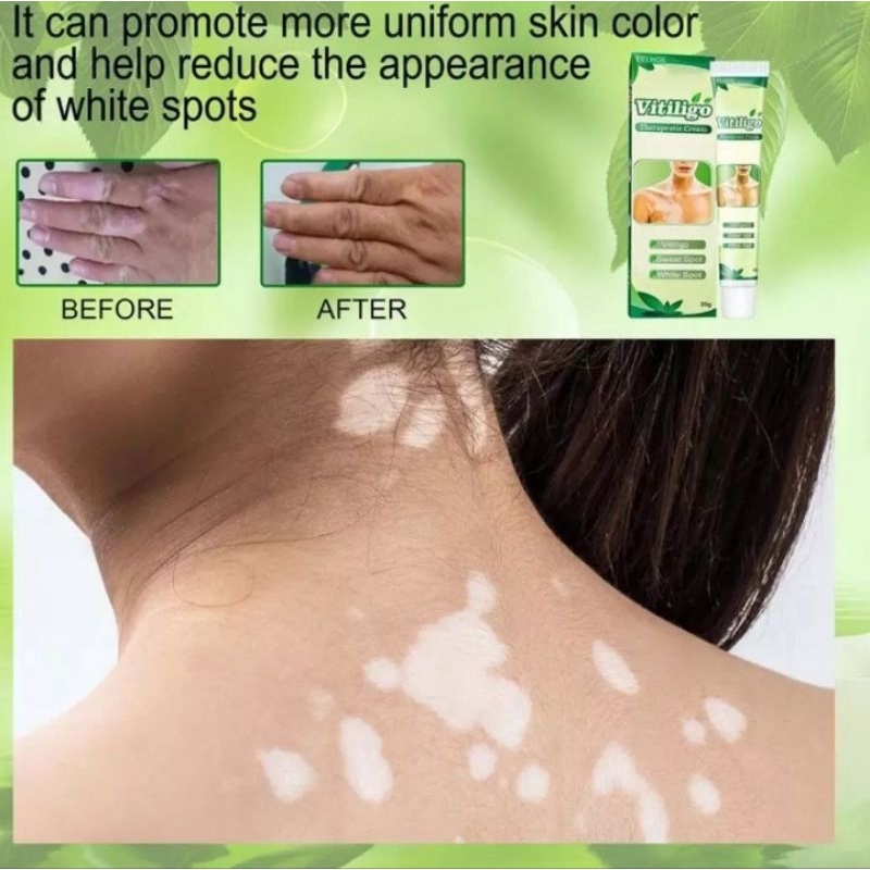 READY SALEP VITILIGO 100% REPIGMENTASI HERBAL AMPUH MENGOBATI BERCAK PUTIH KULIT TIANGE solaren sola