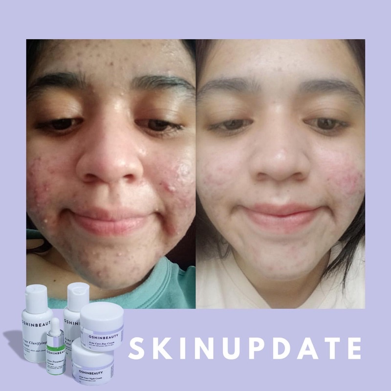(OSHINBEAUTY) Paket Skincare Glow dan Acne Series Complete BPOM [Free Gift/Bonus]-8