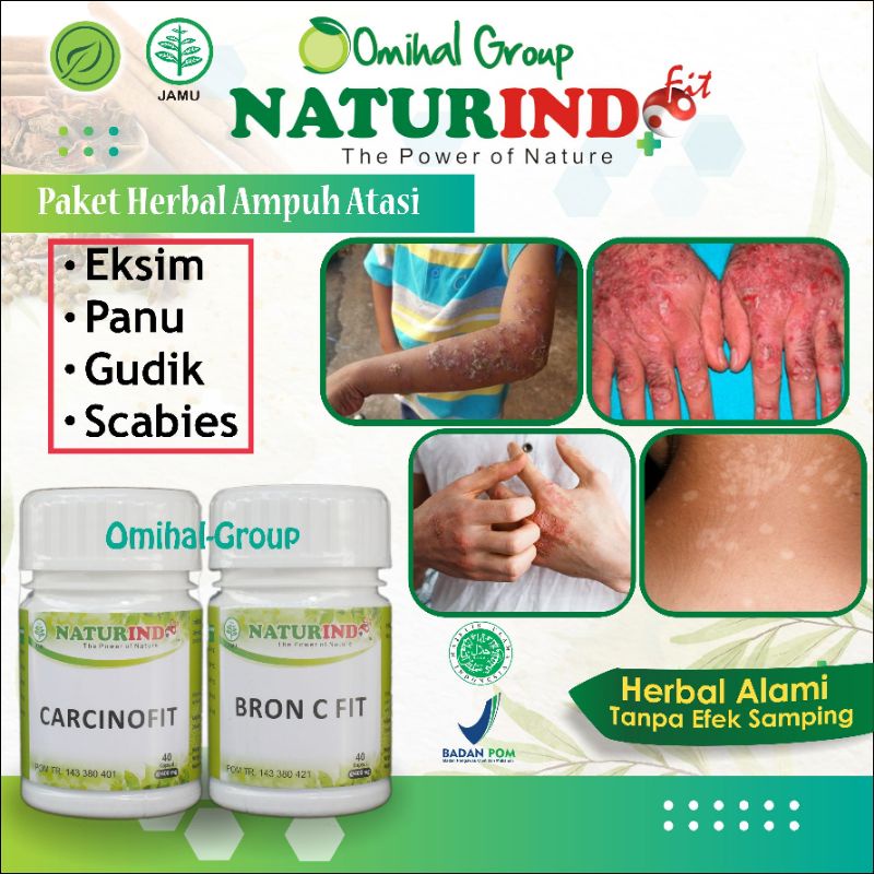 Jual Obat Panu Akut Jamur Kulit Kadas Kurap Gatal Gudikan Eksim