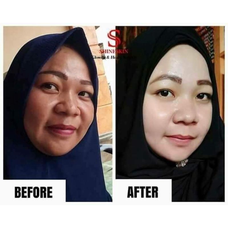 PAKET KLASIK FLEK HITAM SHINESKIN SKINCARE