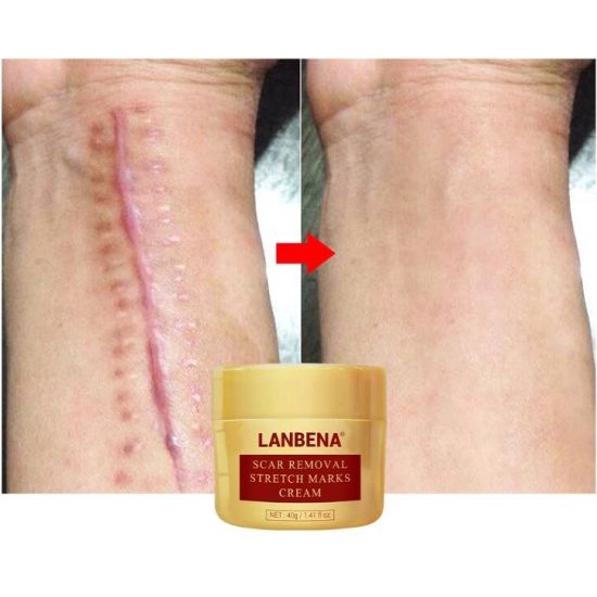 Lanbena Scar Removal Stret Marks Cream / krim Penghilang Bekas Luka / Oprasi