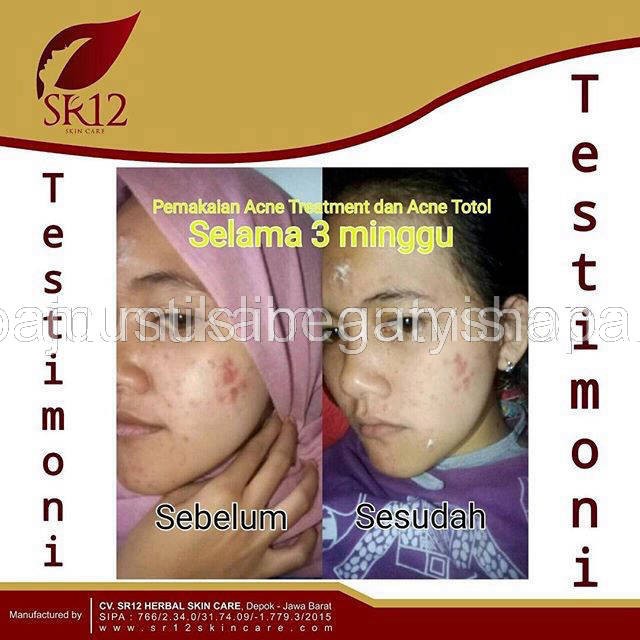 SR 12 KRIM JERAWAT ACNE  TOTOL - ACNE SERUM -ACNE MOISH- Toner acne  SR12 BPOM AMAN / MENGEMPESKAN JERAWAT / CREAM TUMPAS JERAWAT / PERAWATAN JERAWAT