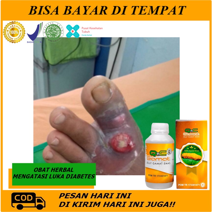 Obat Diabetes basah,Obat luka diabetes, obat diabet, obat gula diabetes, Salep Oles Borok Diabetes T