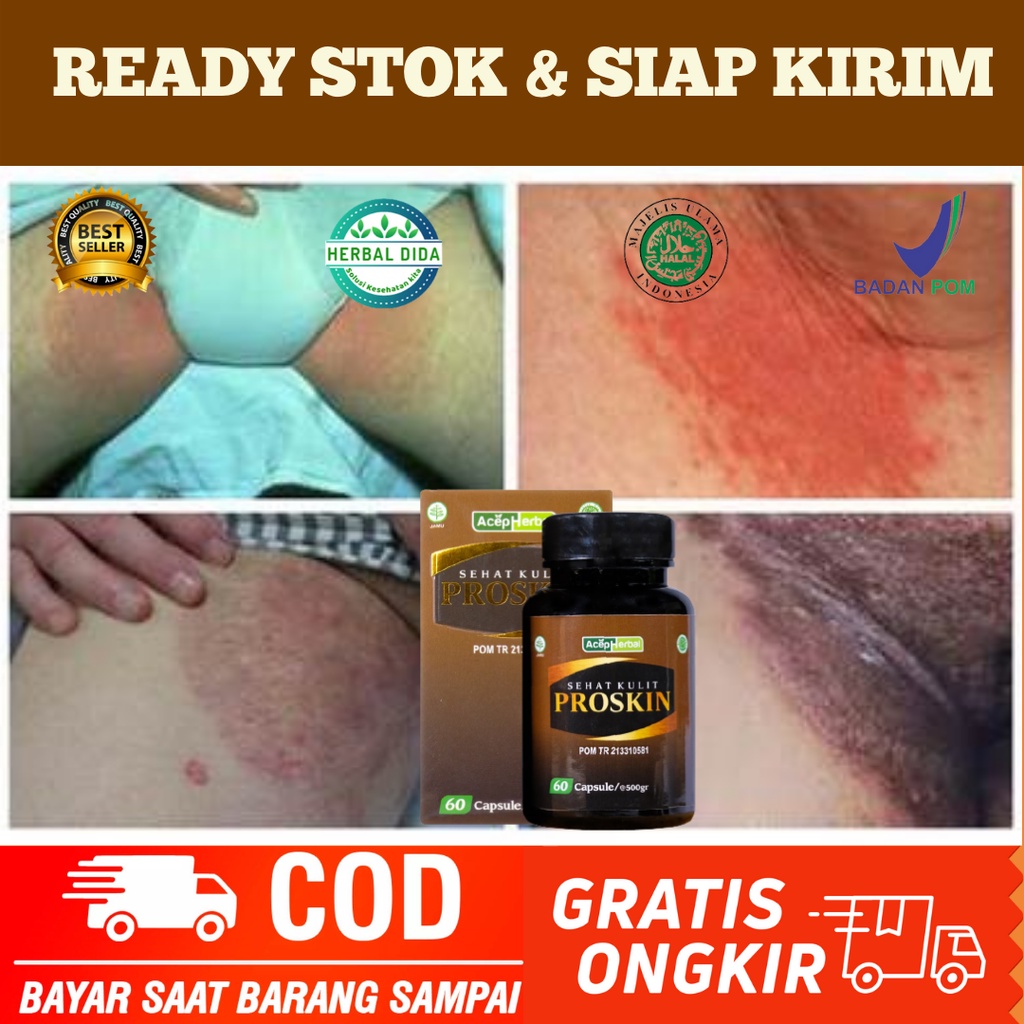 Jual Obat Gatal Selangkangan Kemaluan Obat Gatal Selangkangan Obat Herbal Jamur Sekitar