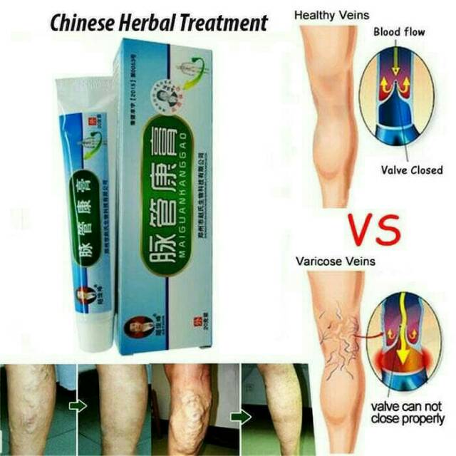 Obat Herbal Varises (Salep Varises)