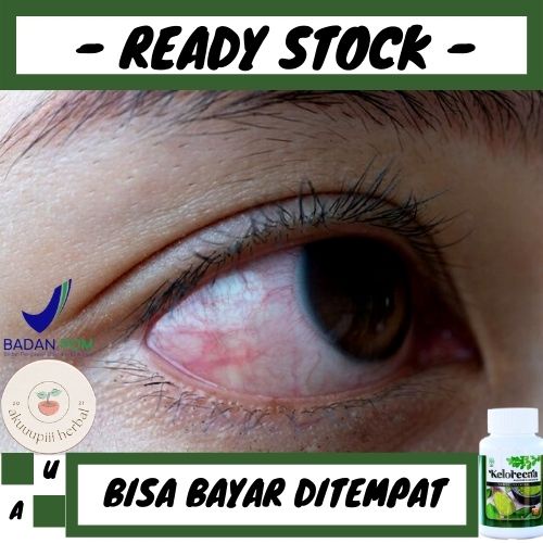 Obat Herbal Ablasi Retina, Obat Ablasio Retina, Obat Retina Lepas, Obat Kesehatan Mata - Obat Herbal