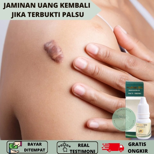 obat bekas luka, obat keloid, Obat herbal penghilang keloid, Obat keloid menahun, PENGHILANG BEKAS L