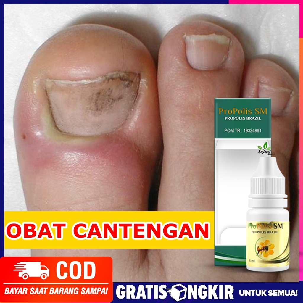 Jual Obat Tetes Cantengan Pada Jempol Kaki Obat Kuku Cantengan Obat Cantengan Bernanah 4617