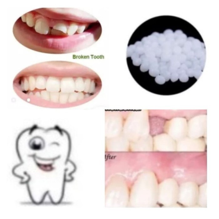 FMFIT Fident Dental Filling