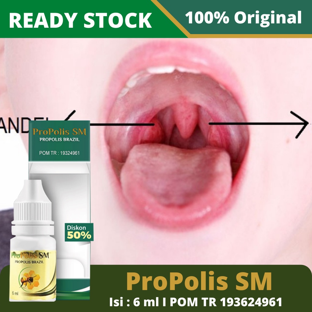 Obat Amandel, Obat Amandel Anak Dan Dewasa, Obat Radang Tenggorokan Anak Dan Dewasa Herbal, Obat Amandel Kronis, Obat Amandel Berwarna, Obat Amandel Bengkak, Amandel Gatal – ProPolis SM Herbal Alami 100% Original