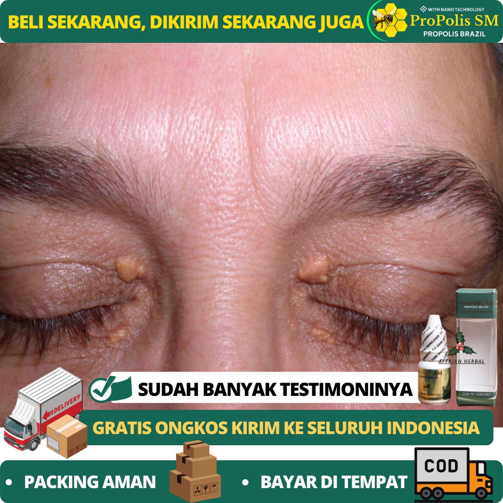 Jual OBAT GUMPALAN LEMAK DI MATA - OBAT XANTHELASMA GUMPALAN LEMAK DI ...