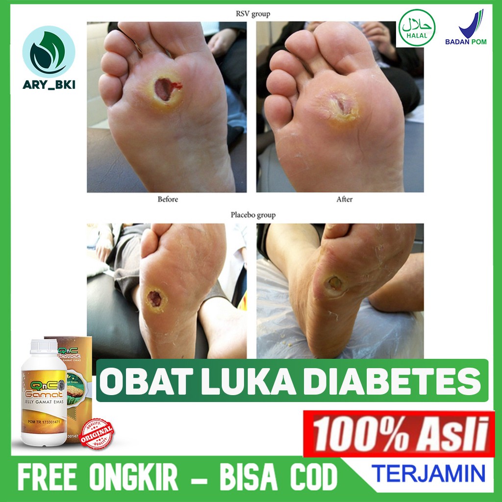 Obat Luka Diabetes - Luka Diabetes Basah - Luka Gangren - Kaki Bolong Herbal QnC Jelly Gamat ASLI