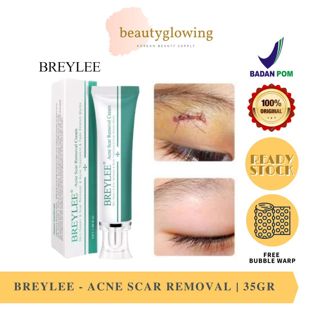 BREYLEE Acne Cream Krim Penghilang Noda Bekas Jerawat, Luka &amp; Stretch Mark (30g)