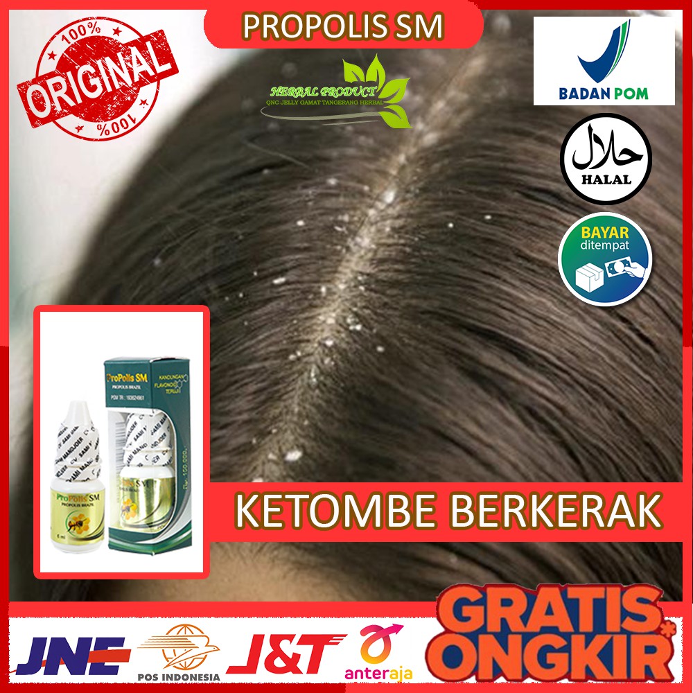 Obat Ketombe Berkerak, Ketombe Menahun, Ketombe Basah, Ketombe Kering - Propolis Sm di Tangerang