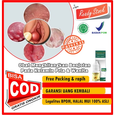 Jual Obat Menghilangkan Benjolan Pada Kelamin Pria Wanita Kista