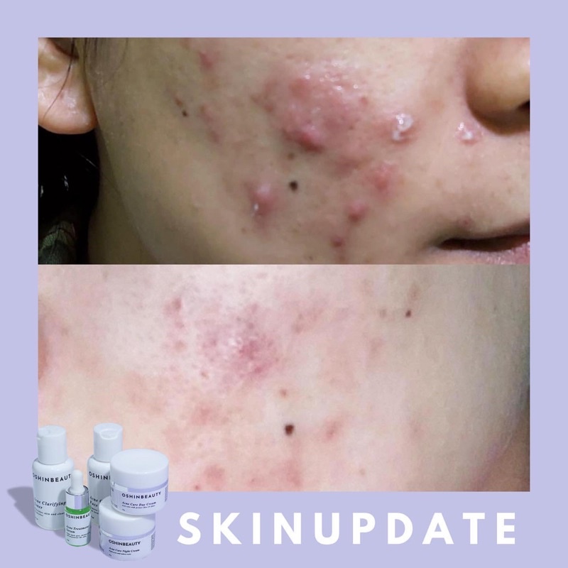 (ECER ACNE) OshinBeauty - Acne Series Oshin Beauty Skincare [Free Gift]-8