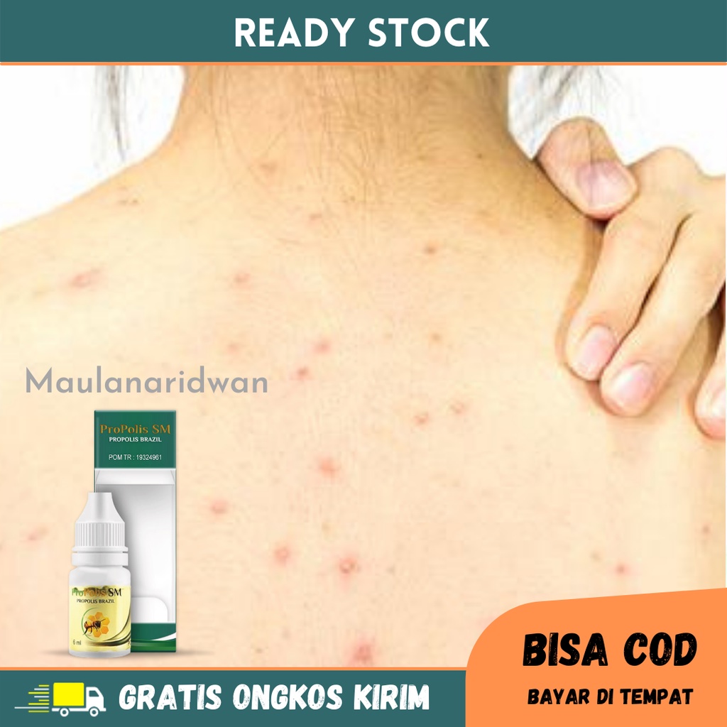 Obat Gatal Gatal Di Seluruh Badan, Gatal Alergi, Infeksi Jamur, Kulit Gatal Menahun, Obat Gatal Bint