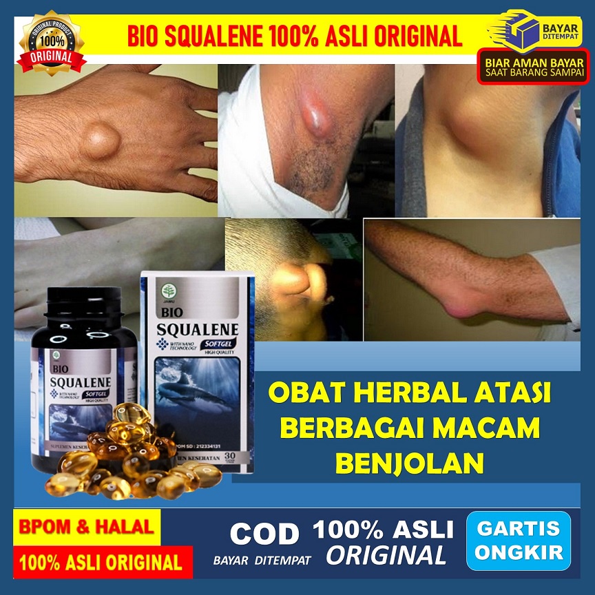 Obat Benjolan Di Dahi, Benjolan Di Jidat,Benjolan Di Tangan Dan Kaki, Benjolan Kelenjar Getah Bening
