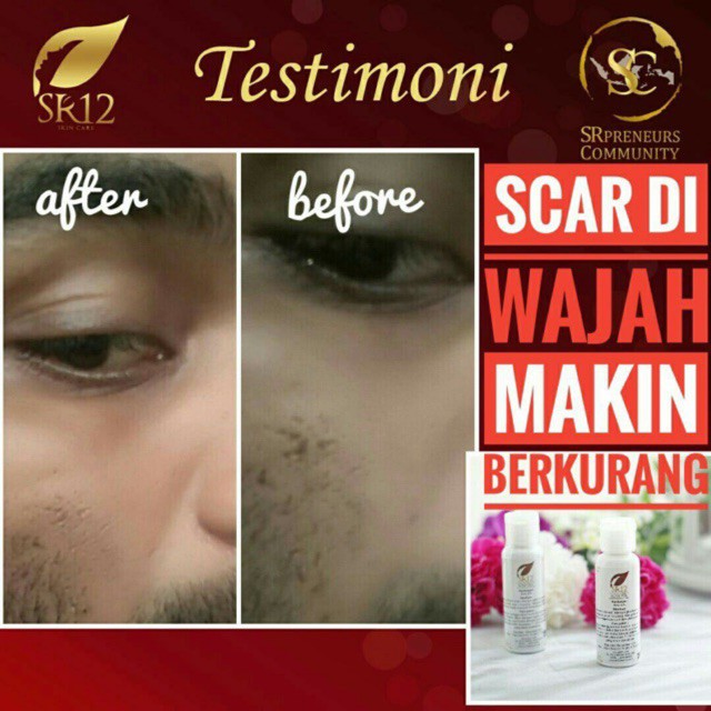 CHEMICAL PEELING ACNE SR12 - ACNE PEEL SOLUSI BOPENG SCAR BHA 30% HILANGKA BEKAS JERAWAT dan bruntus