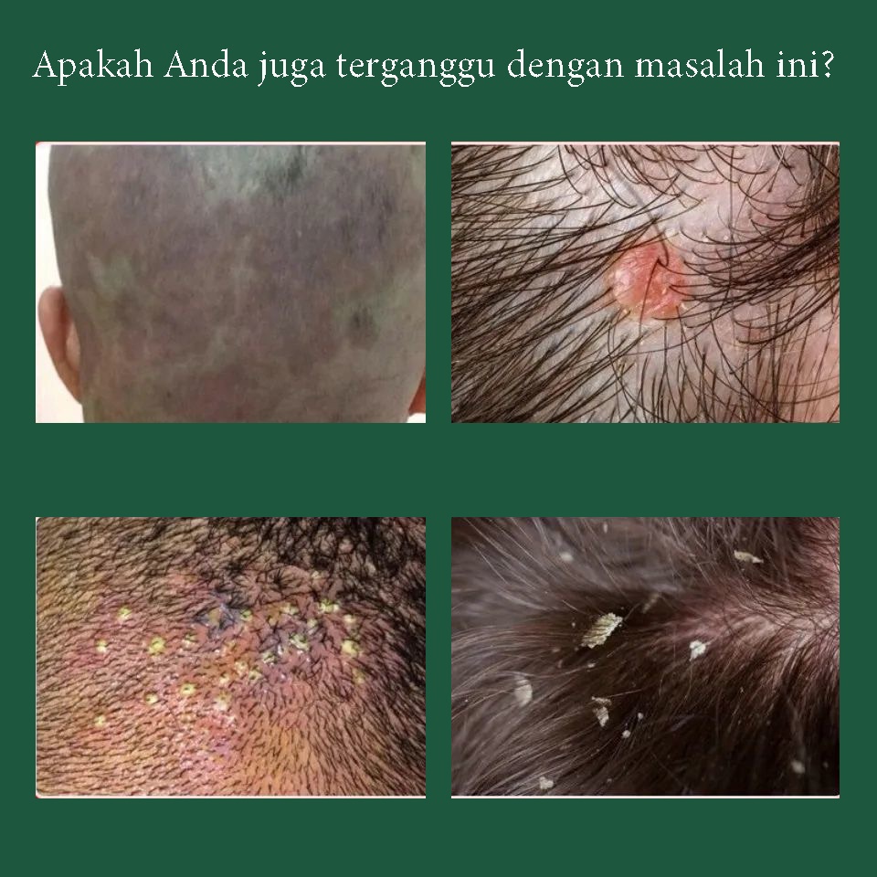 shampo anti ketombe 200g  gatal Shampo Perawatan Kulit Kepala Efektif memelihara kulit dan menumbuhkan rambut bergizi