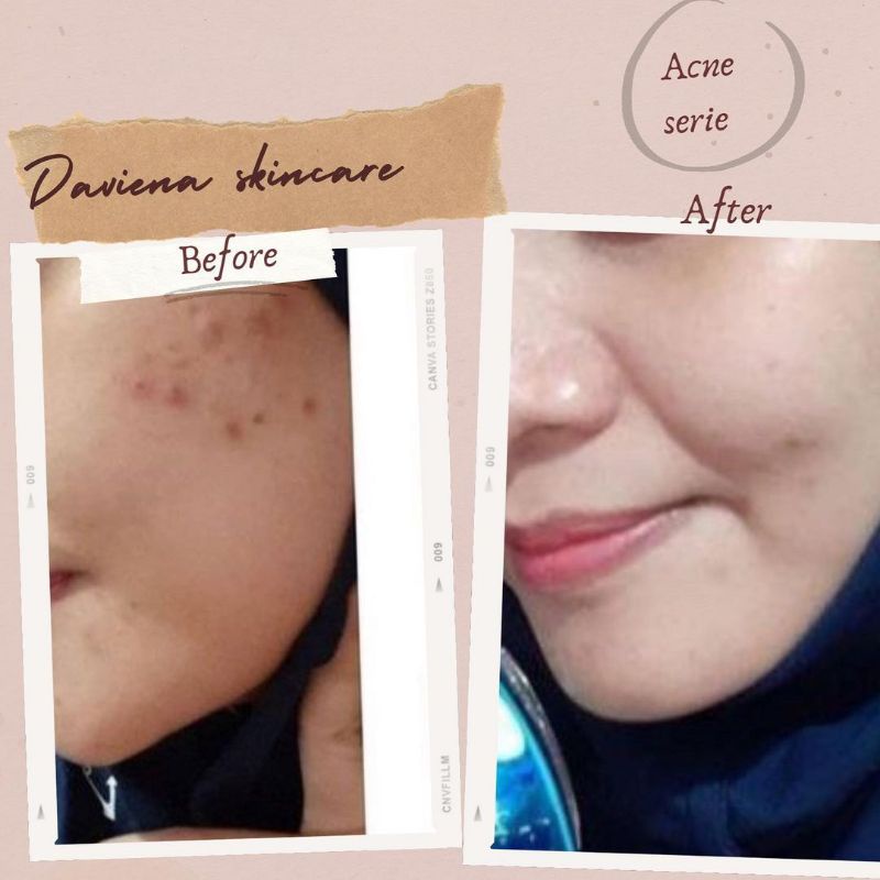 PAKET LENGKAP ACNE SERIES DAVIENA DAVINA DEVIENA SKINCARE LIVE |KRIM JERAWAT  OFFICIAL STORE  | AGEN RESMI | KRIM BPOM ORIGINAL DEPOK JAKARTA JABODETABEK