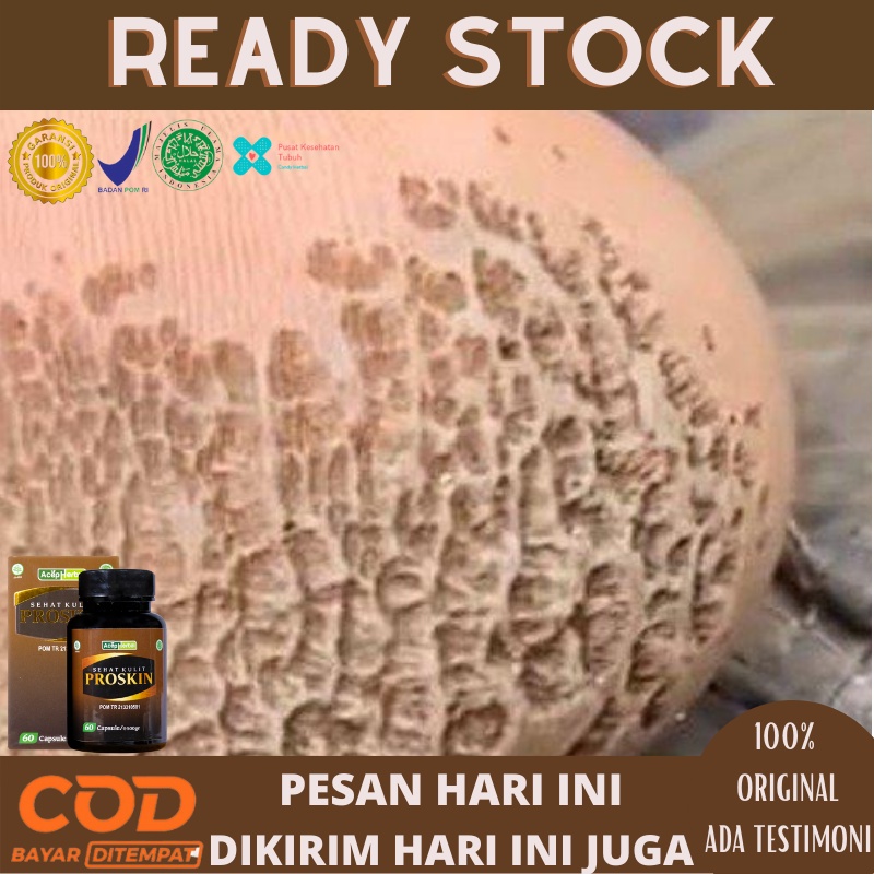 Jual Obat Penghilang Kaki Rayapan Obat Telapak Kaki Bolong Obat Herbal Kaki Rayapan Obat