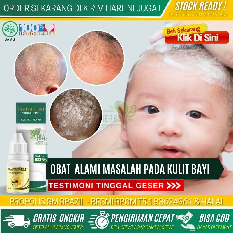 Salep Untuk Iritasi Kulit Kepala Bayi, Obat Oles Ruam Merah Merah Di Kepala Bayi, Menghilangkan Kuli