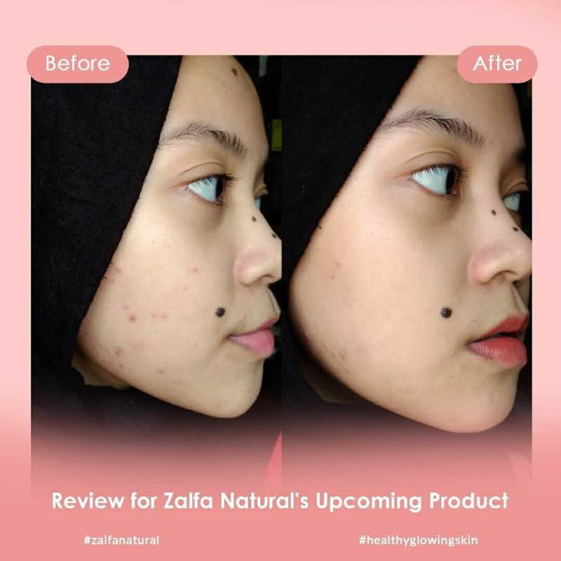 Zalfa Natural Skincare Skincare Probio Herbs Bakuchiol Peptide Acne Ampoule-5
