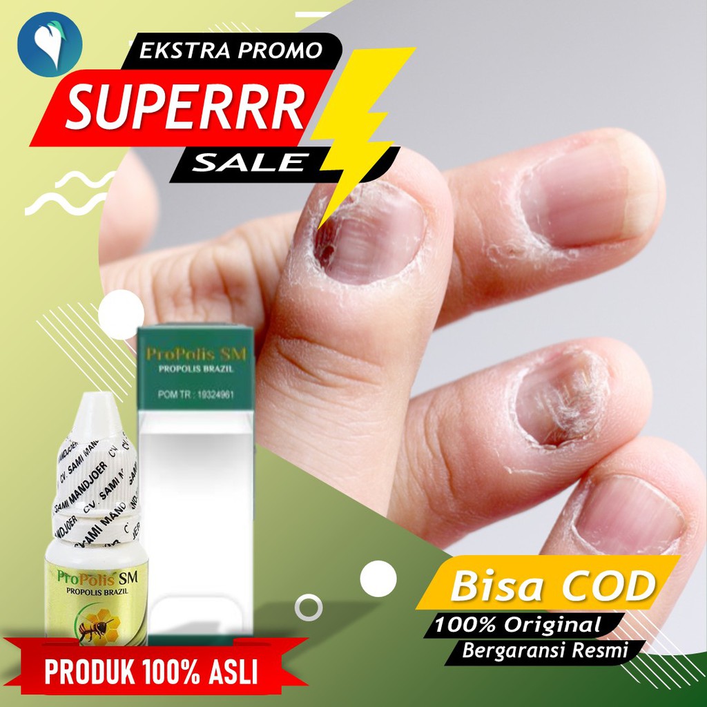 Obat Kuku Jamur Dan Rusak Jamur Kuku Tangan Dan Kaki Kuku Hitam Kuku Busuk Propolis Sm Brazil Ori Shopee Indonesia