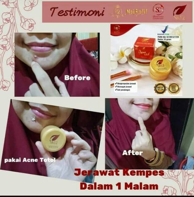 Acne Totol SR12 Penghilang Jerawat dan Bekas Jerawat acne Treatment Obat Totol Jerawat Krim Totol Atasi Jerawat Salep Jerawat Lotion Jerawat Krim Jerawat Krim Anti Jerawat Cream Jerawat Parah Meradang Bopeng Gel Anti Jerawat Acne Glow Krim Sulfur