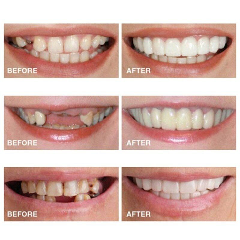 Gigi Palsu Instan Perfect Smile Veneer Gigi Tiruan Bagian Atas