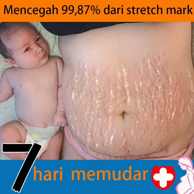 Penghilang strechmark  Strechmark cream Secara efektif menghilangkan stretch mark  Aman dan efektif