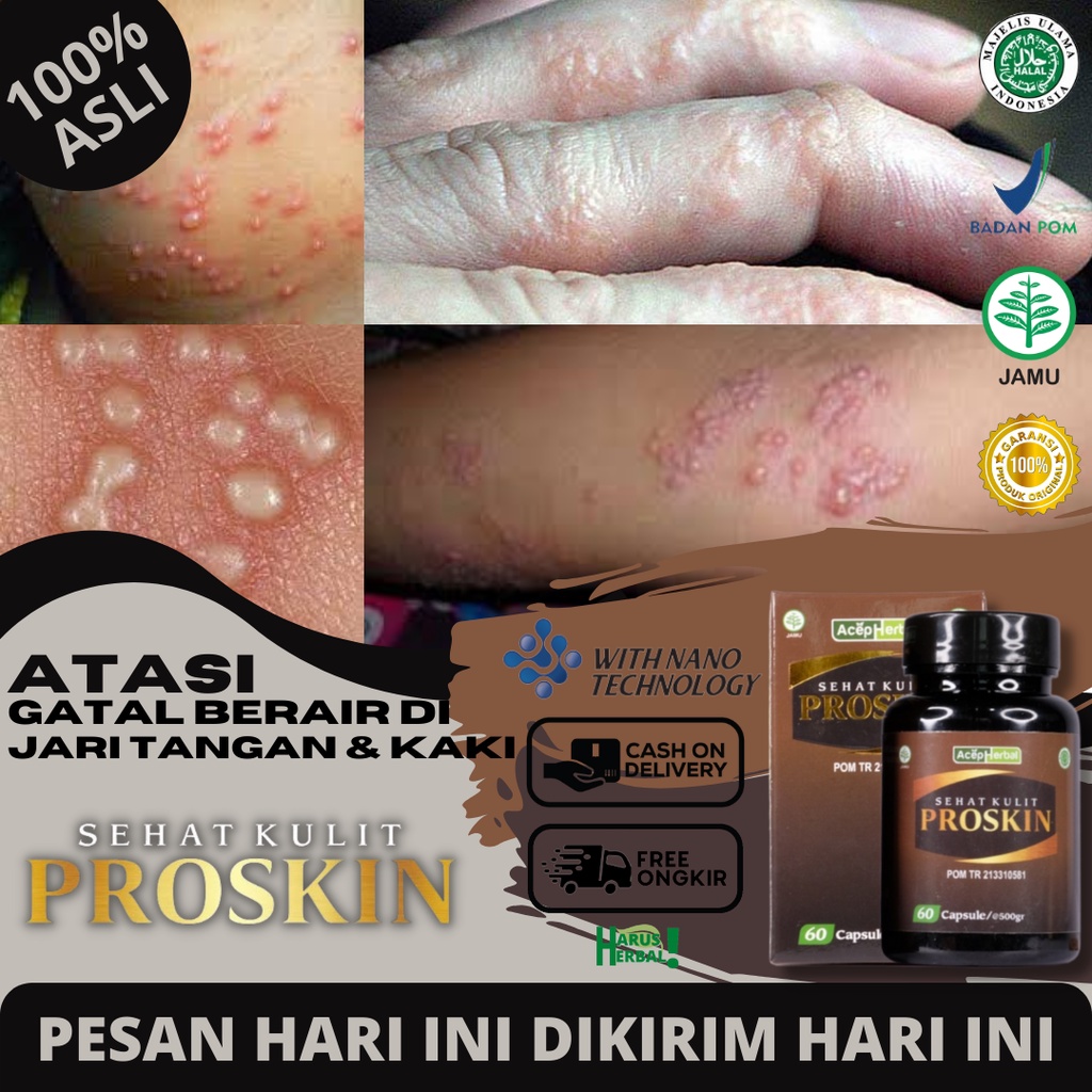 Obat Kulit Gatal Berair, Obat Beruntusan Bening Di Jari Tangan & Kaki, Obat Gatal Berair Dan Menyeba