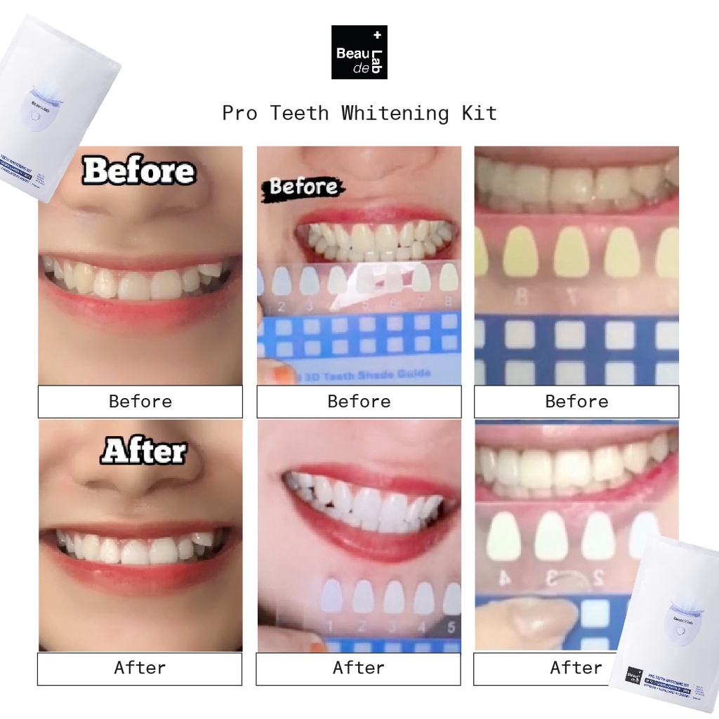 Beaudelab Deluxe Pemutih Gigi Permanen | Teeth Whitening Kit | Alat Pemutih Gigi Cepat Lampu LED [BEAUDELAB TEETH]