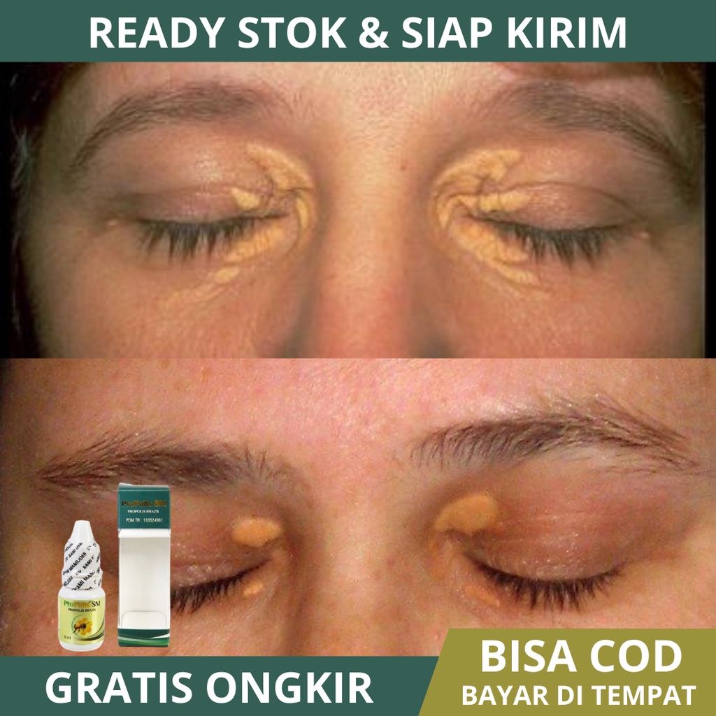 Obat Xanthelasma, Obat Herbal Mata Xanthelasma, Obat Penghilang Xanthelasma, Flak Kuning di Sudut Ma