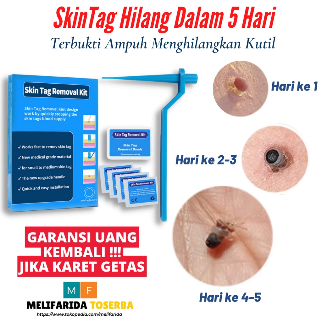 Jual Skin Tag Rubber Band Removal Tool Kit Penghilang Kutil dan Tahi Lalat Wart Remover Shopee