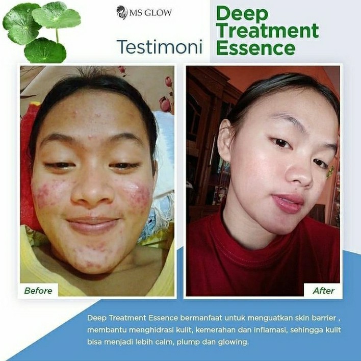 LT- [150GR] DTE - MS GLOW DEEP TREATMENT ESSENSE BPOM