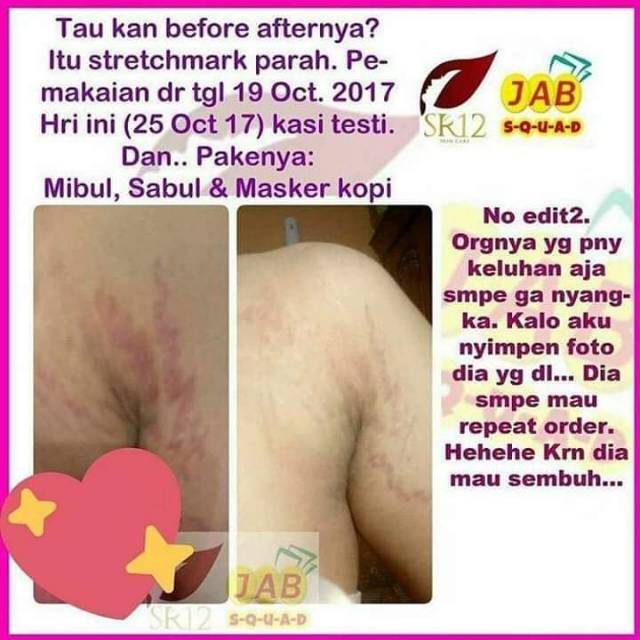 SR12 PAKET PENGHILANG STRETCHMARK / MENGENCANGKAN KULIT / MENCERAHKAN KULIT / MENGHILANGKAN BEKAS LUKA ATAU GATAL