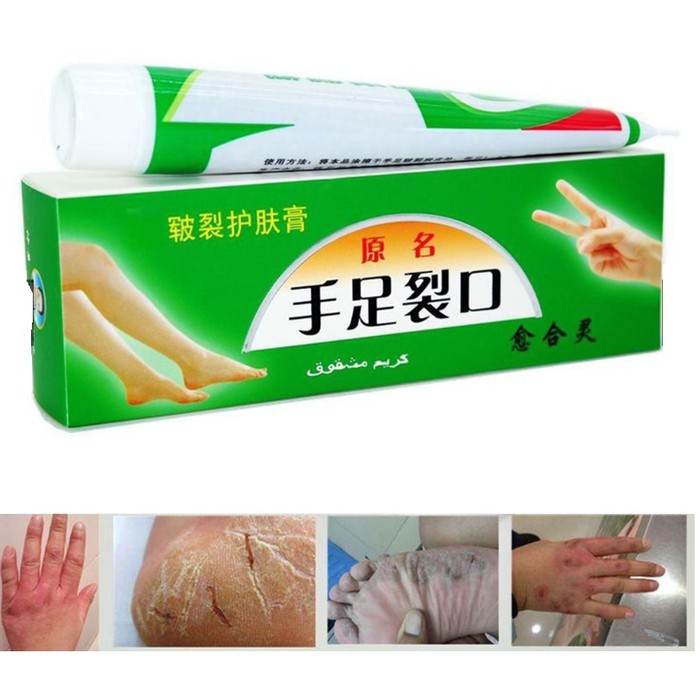 Obat Tumit Pecah Pecah Salep Tumit Pecah Pecah Ampuh Shopee Indonesia