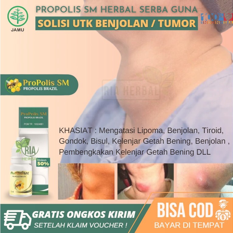 OBAT BENJOLAN DIBAWAH DAGU TRADISIONAL, Penghilang Kelenjar Getah Bening Di Dekat Leher Tumor Jinak