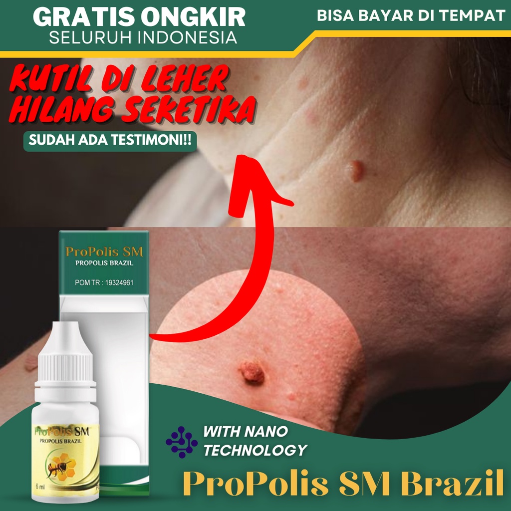 Obat Papiloma, Obat Penghilang Papiloma / Skin Tag, Obat Papiloma di Leher, Obat Penghilang Papiloma