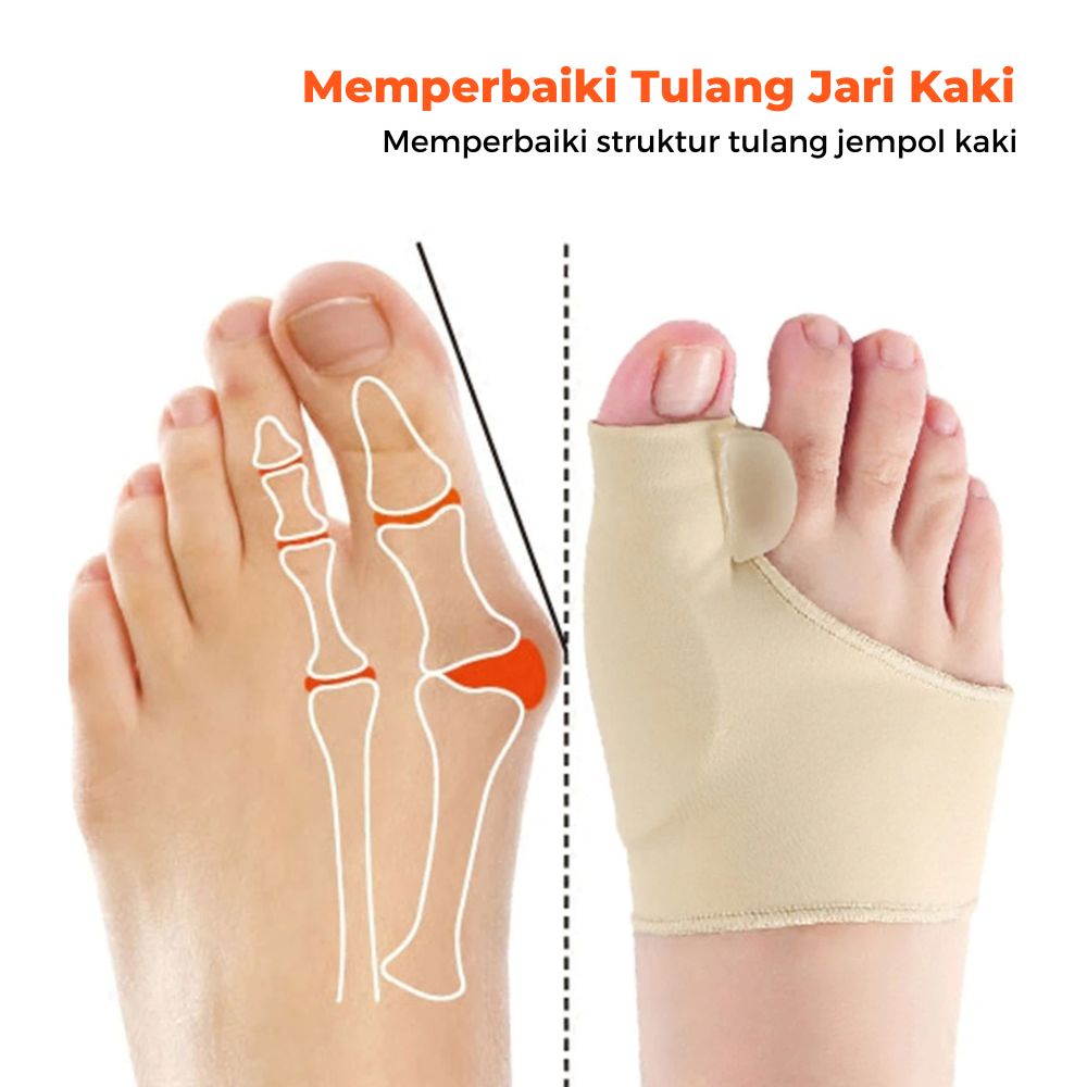 MARKETBIX Alat Terapi Sleeve Korektor Tulang Jempol Kaki Bunion Bengkok Hallux  Orthotics Sepasang