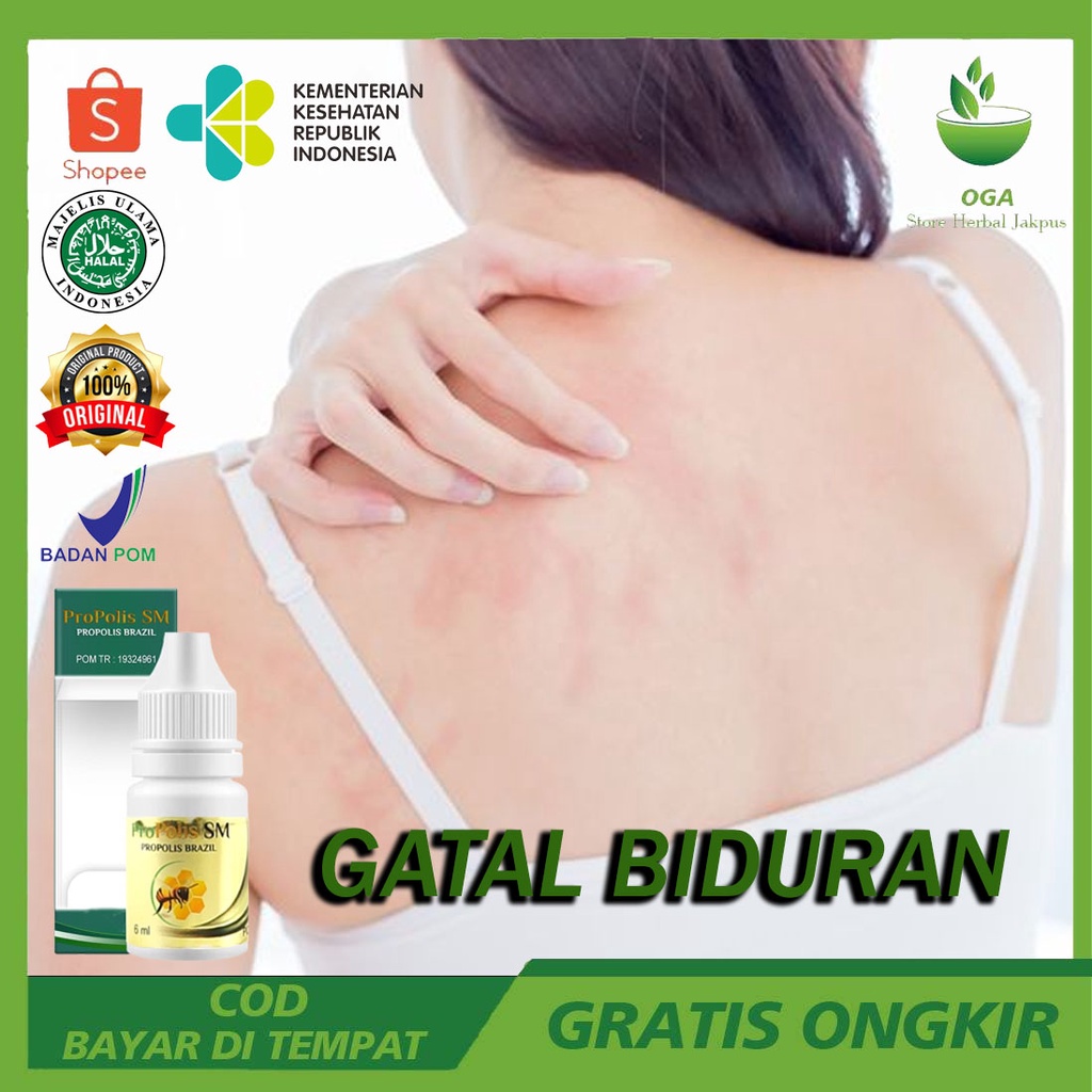 Obat Gatal Gatal Biduran Biduran Gatal Alergi Dingin Biduran Menahun Biduran Gatal Gatal Oles