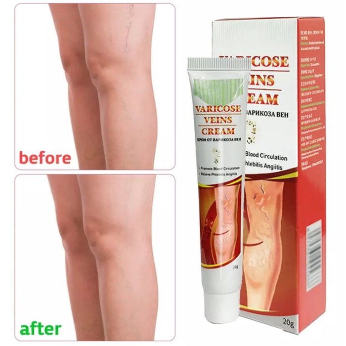 OBAT CREAM HILANGKAN VARISES SEMBUH PERMANEN - CREAM VARICOSE VEINS