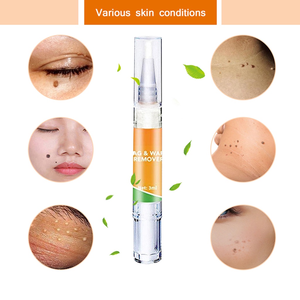 [100% Asli] Krim Obat Penghilang Kutil Badan Krim Penghilang Tanda Kulit Tahi Lalat