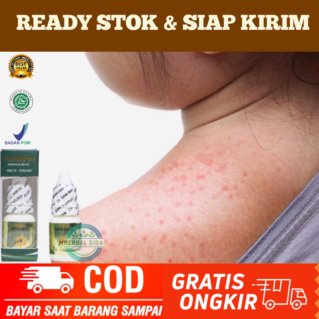 Obat Oles Biang Keringat Dewasa, Obat Oles gatal alergi biang keringat, Obat Oles Biang Keringat Gat