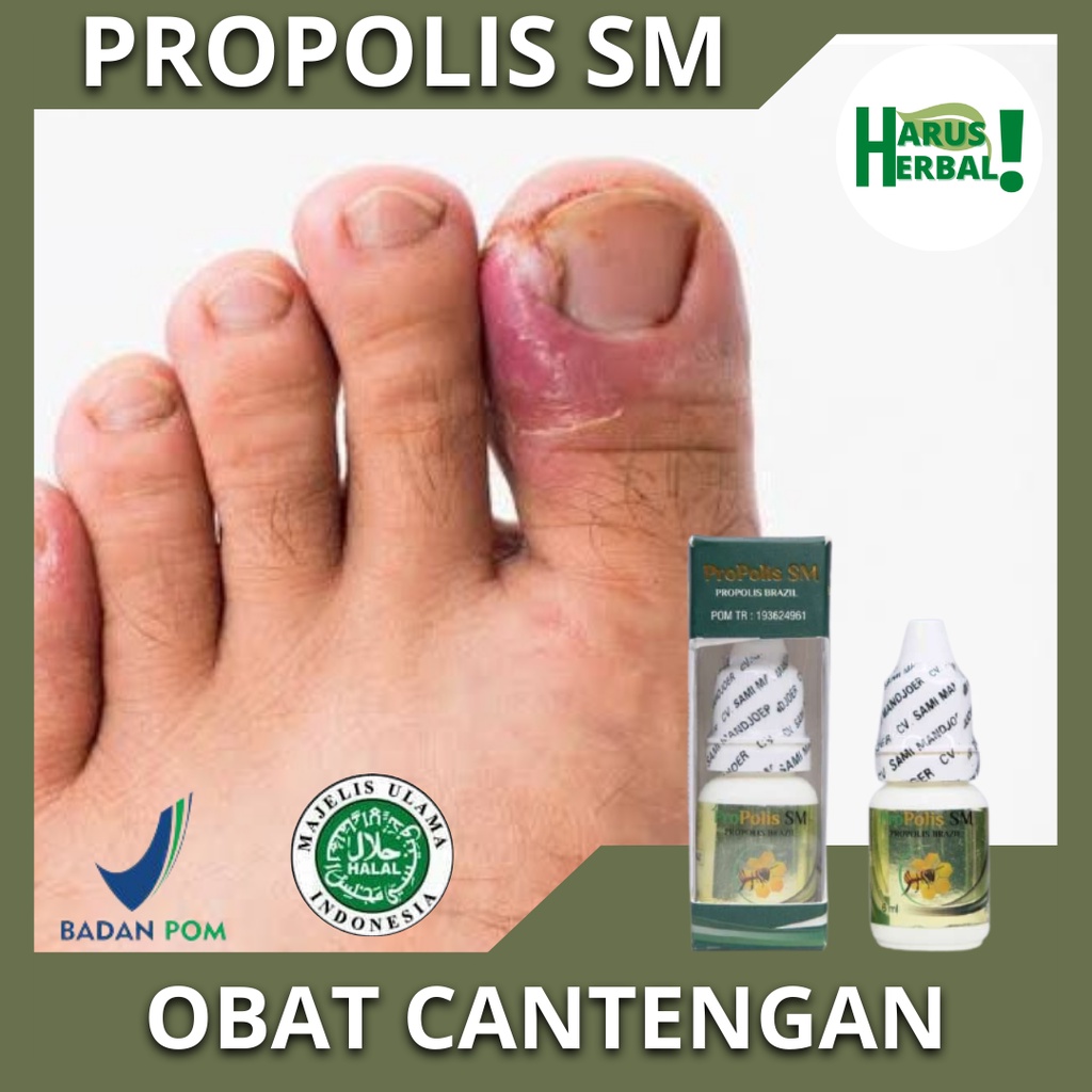 Obat Cantengan, Cantengan Di Jempol Kaki, Obat Kuku Cantengan, Obat Cantengan Kuku Tangan, Obat Jamu
