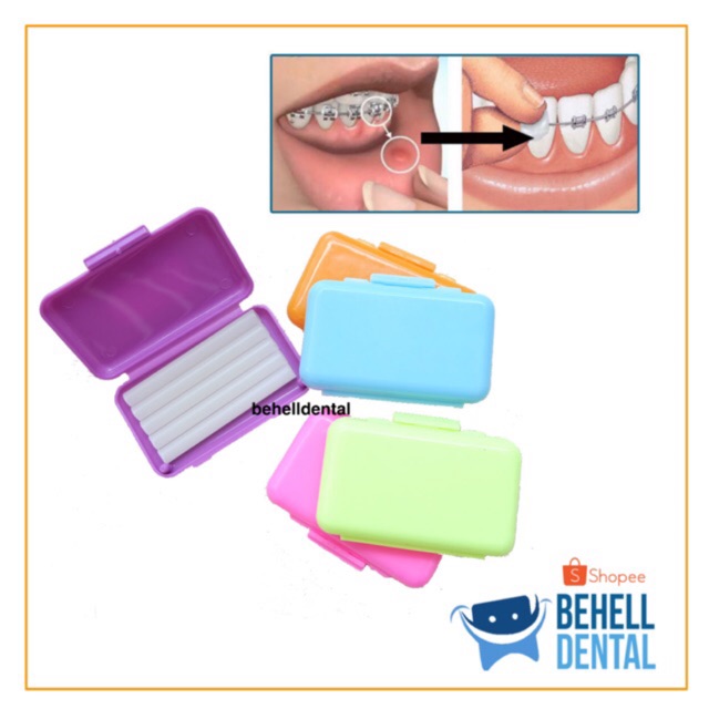Behelldental Wax Ortho Pencegah Sariawan . Lilin behel dental . Kawat gigi