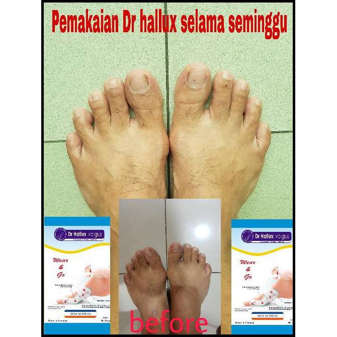 BUNION THERAPHY DR HALLUX VALGUS MANJUR